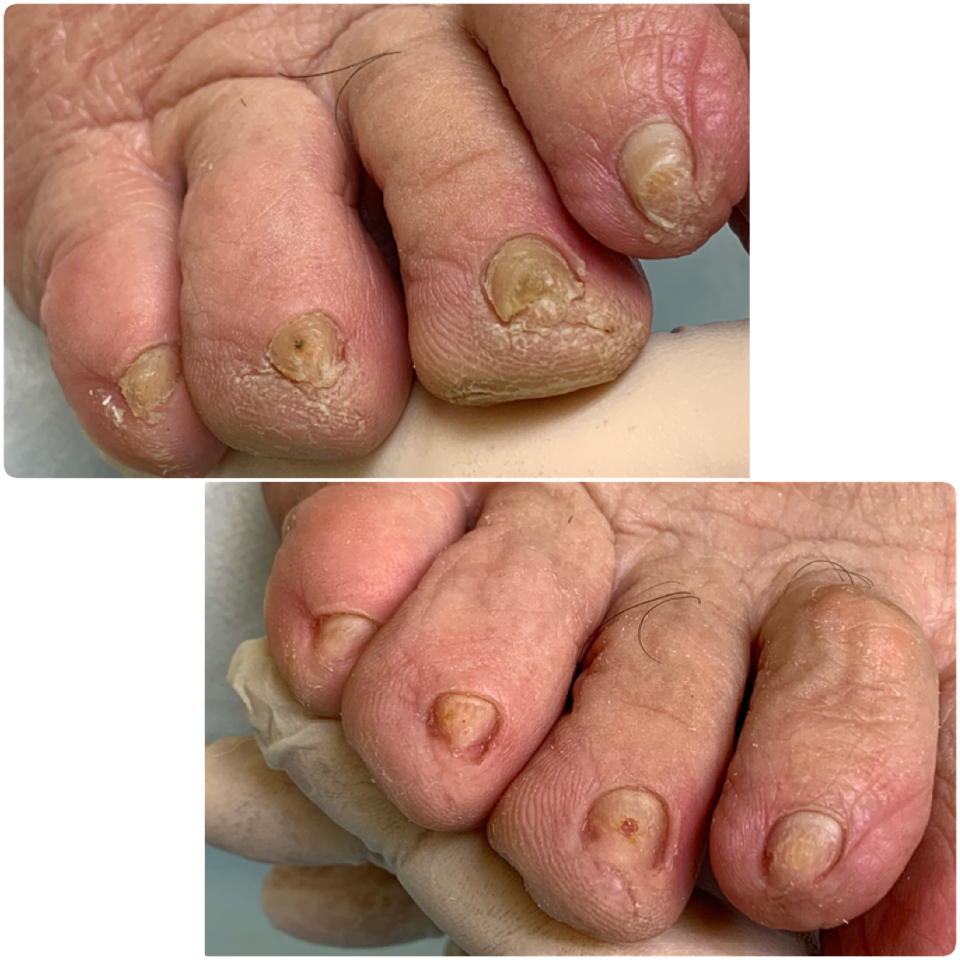 Чистка ногтей пораженных грибковой инфекцией